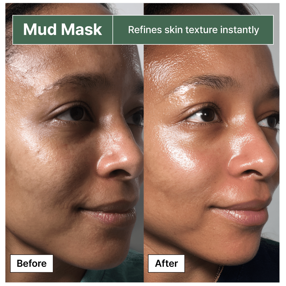 Before and after using BRMUD mud mask showing improved pore clarity